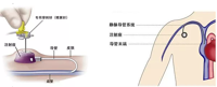 小“纽扣”：植入式输液港，为长期静脉输液患者减轻痛苦！