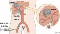 【介入科普】肝肿瘤微创介入术后并发症及术后注意事项！