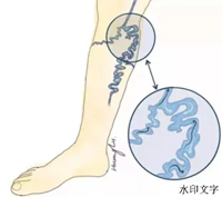 【张医“话”健康】青筋从哪凸，病从哪里出！关于下肢静脉曲张，你想了解的都在这里
