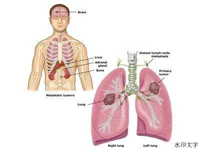 【张医“话”健康】带您了解肺癌为何偏爱脑转移?