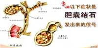 多一点帮助 | 关于胆结石，你知道多少？