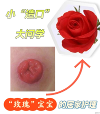 解锁腹壁玫瑰的秘密：肠造瘘口护理全攻略