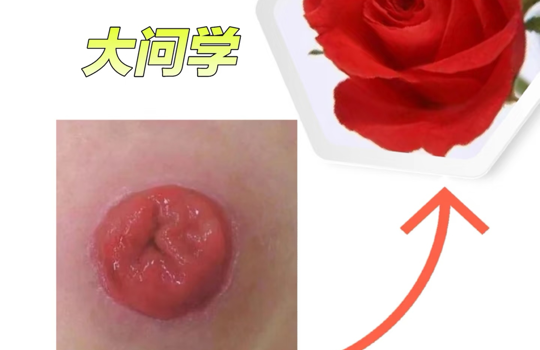 解锁腹壁玫瑰的秘密：肠造瘘口护理全攻略