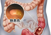 肠道癌症的“潜伏者”——肠息肉