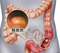 肠道癌症的“潜伏者”——肠息肉