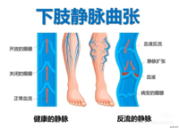 别让健康“堵”在下半身 ——职场人的血管保卫战：久坐久站当心“蚯蚓腿”