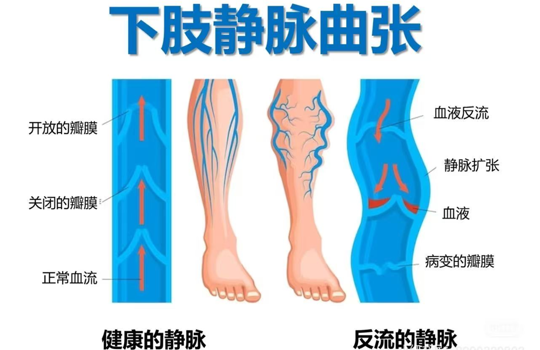 别让健康“堵”在下半身 ——职场人的血管保卫战：久坐久站当心“蚯蚓腿”