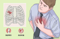 会呼吸的痛——肋骨骨折
