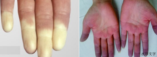 手指发白和青紫是什么原因？警惕风湿免疫系统疾病！