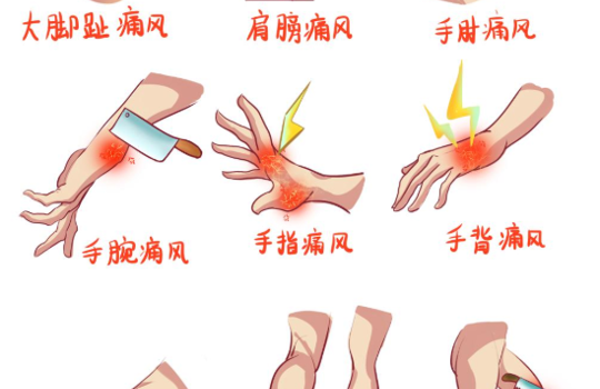 新年吃吃又喝喝，痛风可别“凑热闹”