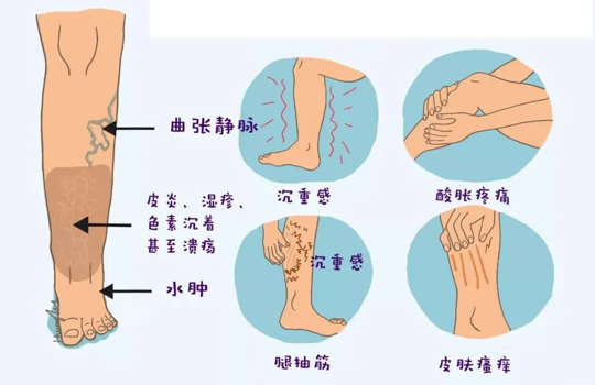 什么是下肢静脉曲张？